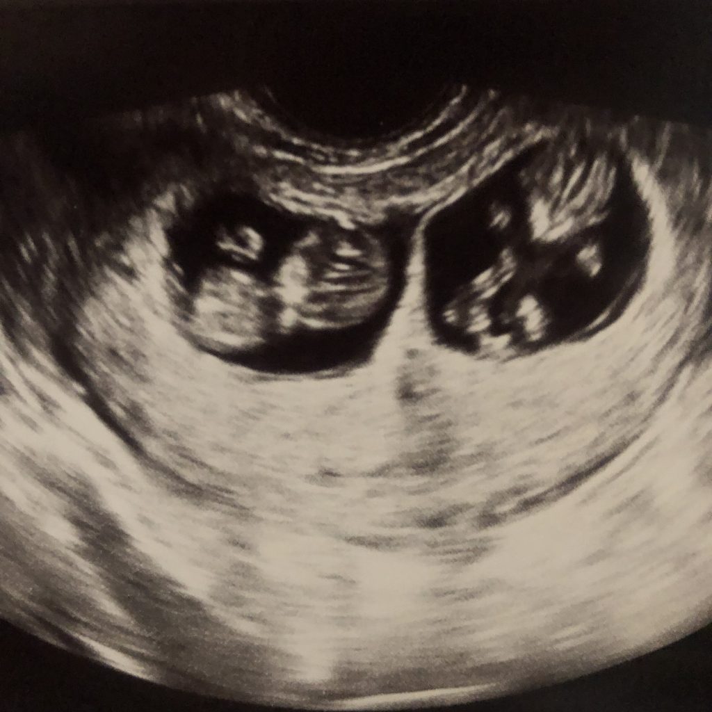 On up when do twins ultrasound show Twins at
