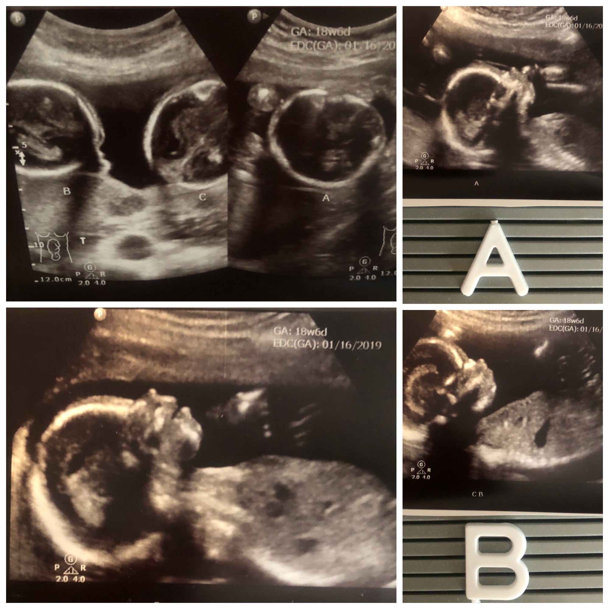 Twin pictures missed ultrasound Can a